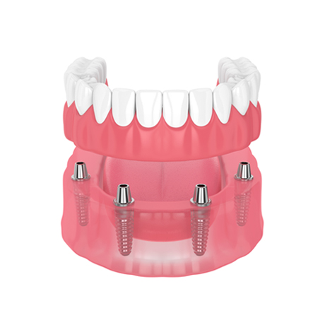 Single and Multiple Implants